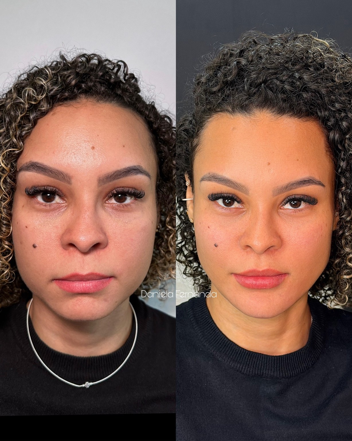 Registro comparativo de resultado facial fornecido pela clínica