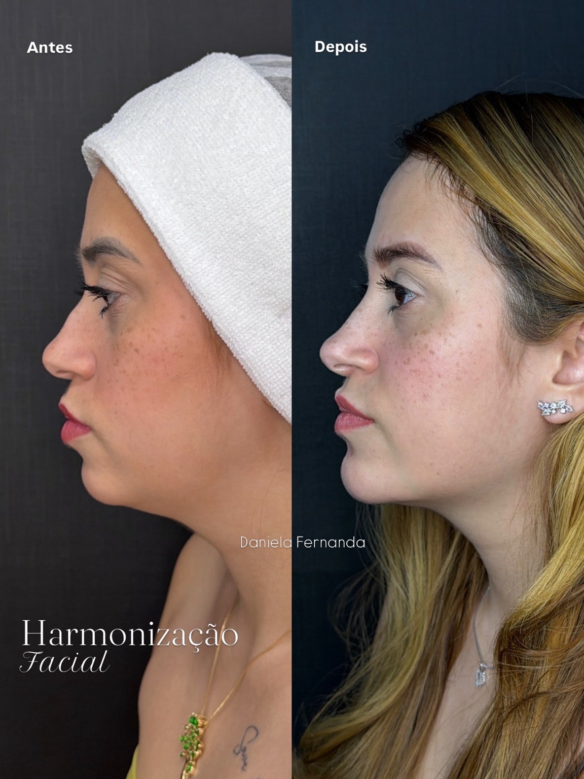 Antes e depois de harmonização facial, em perfil