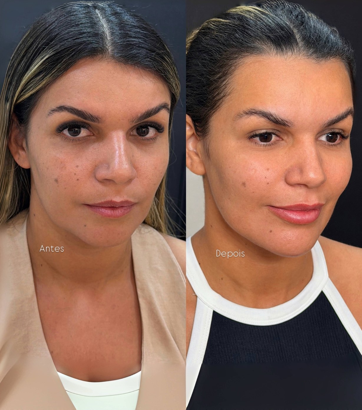 Comparativo de preenchimento facial apresentado pela clínica